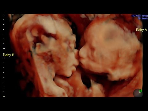 توأم يُقبِّلان بعضهما داخل رحم أمهما