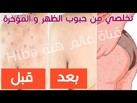 وصفة ستخلصك من حبوب الظهر والصدر والمؤخرة