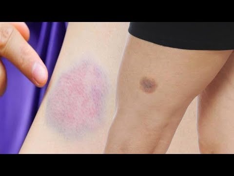 أسباب ظهور الكدمات بشكل مفاجئ في جسم  الإنسان