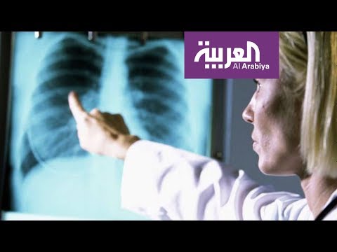 شاهد السيجارة الالكترونية لا تسبب تجمّع الماء في الرئة