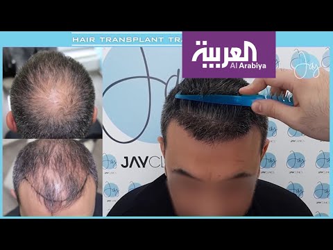 الجديد في علاجات الصلع المبكر بين الفئات العمرية الصغيرة