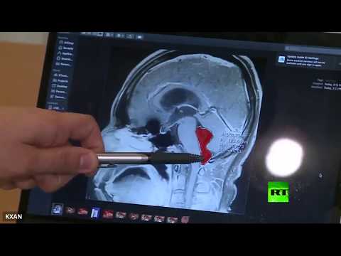 اكتشاف دودة شريطية في دماغ أميركي