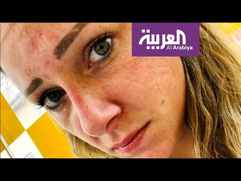 كورونا يترك آثاره على وجوه الطواقم الطبية في إيطاليا