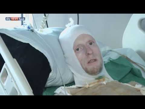 فيديو حروق يوسف ومحمد تصل إلى 80 من الجسد