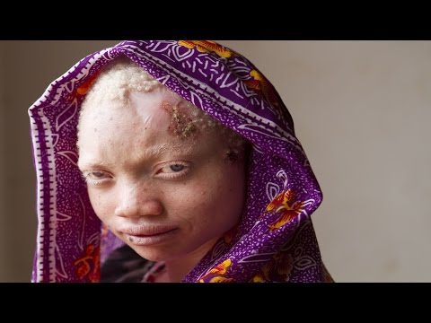 شاهد من هم الألبينو ولماذا تبتر أعضاؤهم  ويفقدون حياتهم