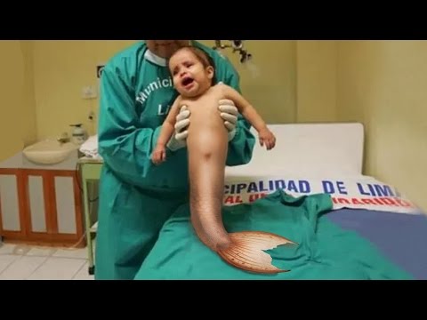أطفال يولدون بأطرف شبيها بزعانف حورية البحر